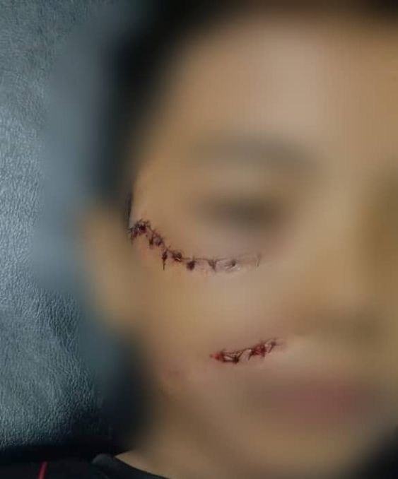 Kanak-kanak terima 20 jahitan di muka